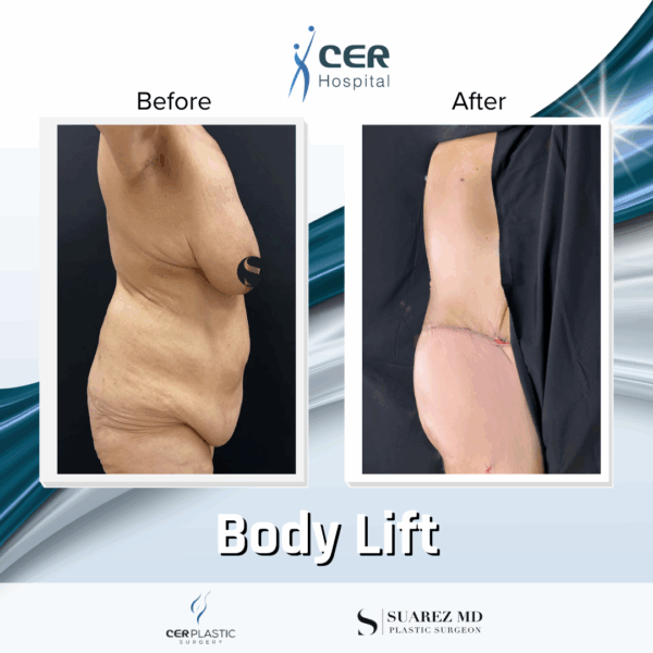 Body Lift - 23013 - Image 8