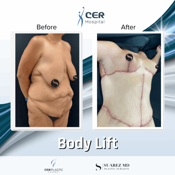 Body Lift - 31074 - Image 8