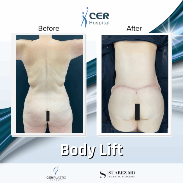Body Lift - 13121 - Image 8