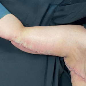 Arm Lift – 24074
