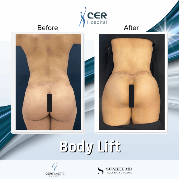 Body Lift - 26043 - Image 8