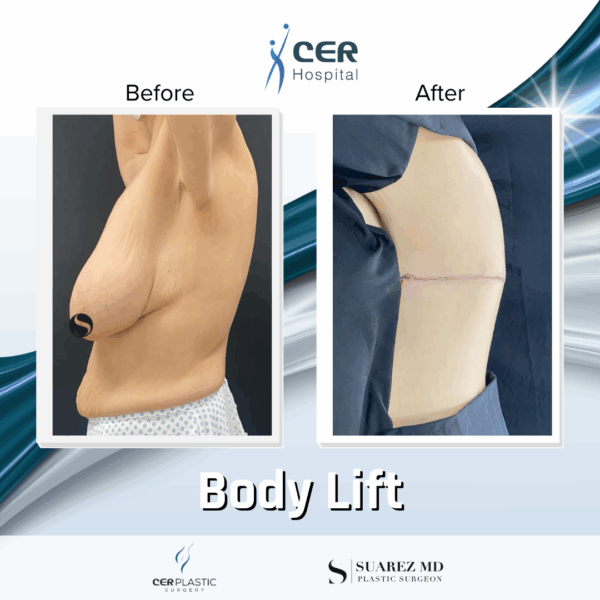 Body Lift - 10043 - Image 9