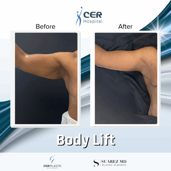 Body Lift - 19043 - Image 9