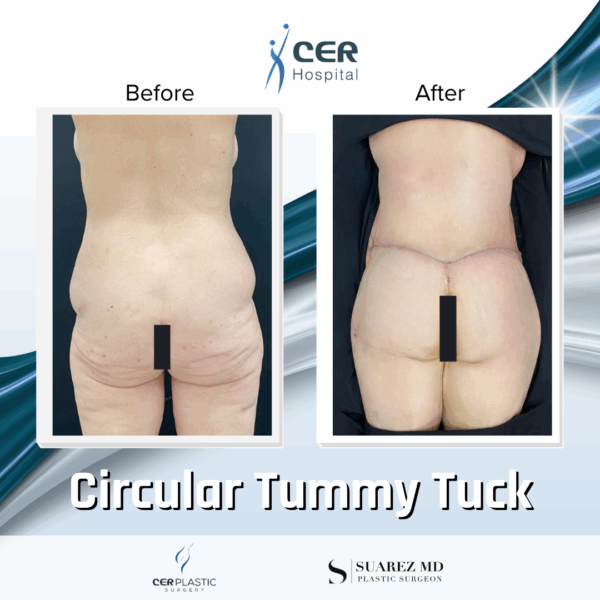 Circular Tummy Tuck - 3043 - Image 8