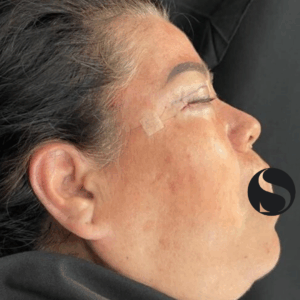 Eyelid Surgery – 5084