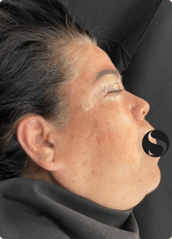 Eyelid Surgery - 5084 - Image 2