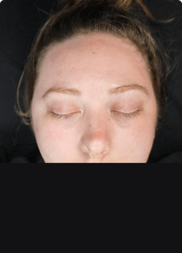Otoplasty - 4094 - Image 2