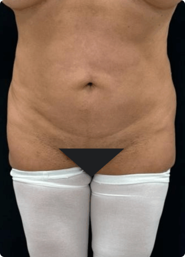 Body Lift - 2104 - Image 3