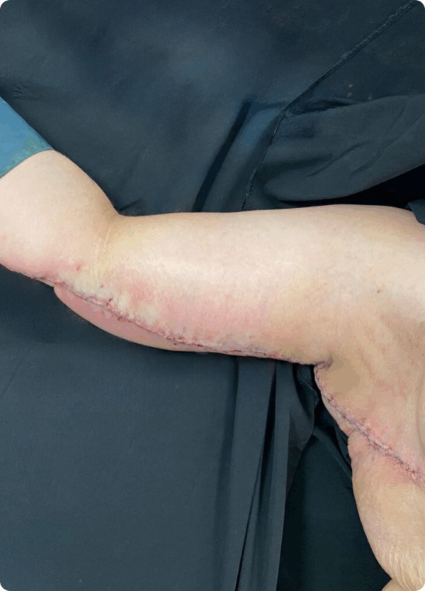 Arm Lift - 24074 - Image 2