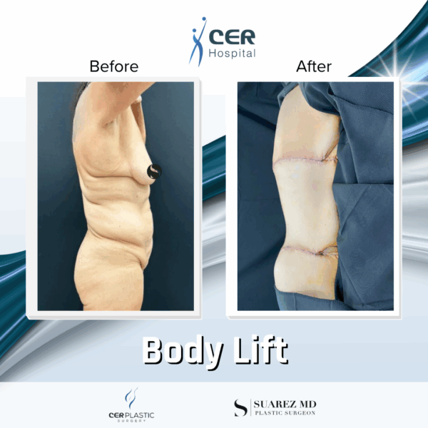 Body Lift - 9104 - Image 5