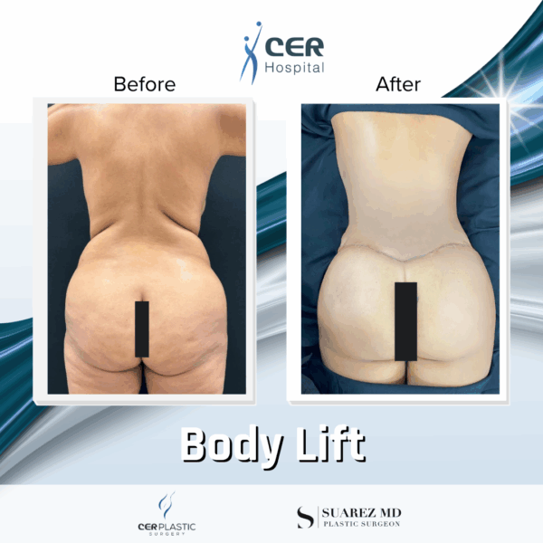Body Lift - 20084 - Image 9