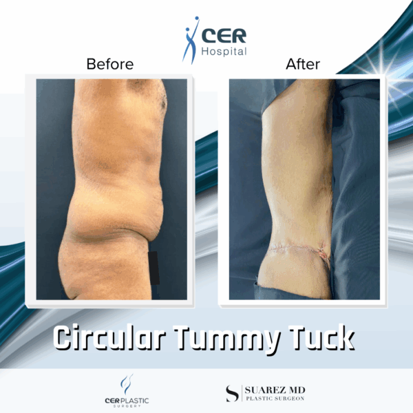 Circular Tummy Tuck - 11104 - Image 8