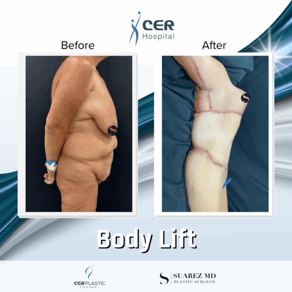 Body Lift - 31074 - Image 9