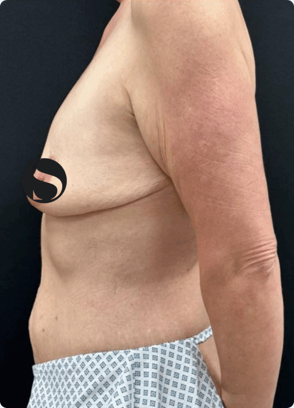 Breast Lift with Implants - 24054 - Image 3