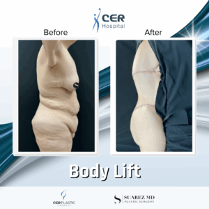 Body Lift – 24104