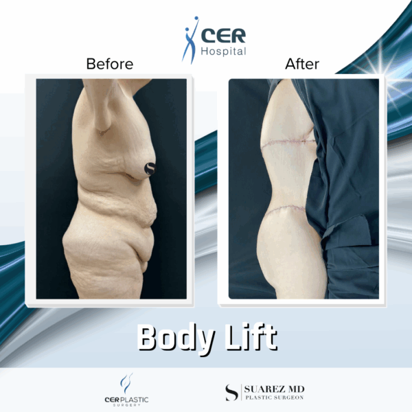 Body Lift - 24104