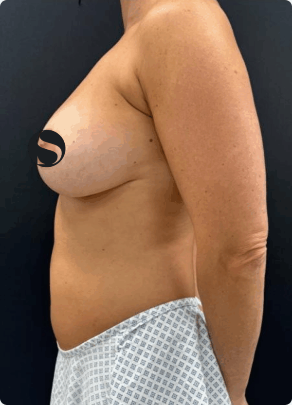 Breast Lift with Implant Exchange - 28104 - Image 3
