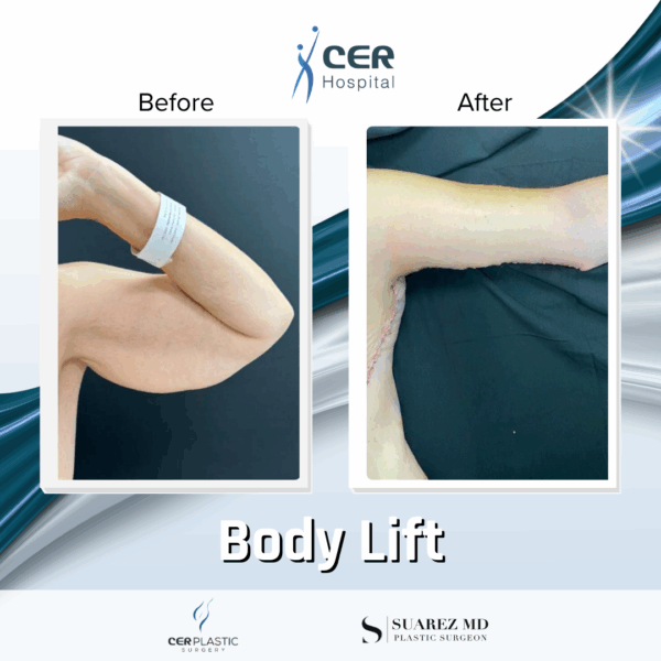 Body Lift - 10124 - Image 9