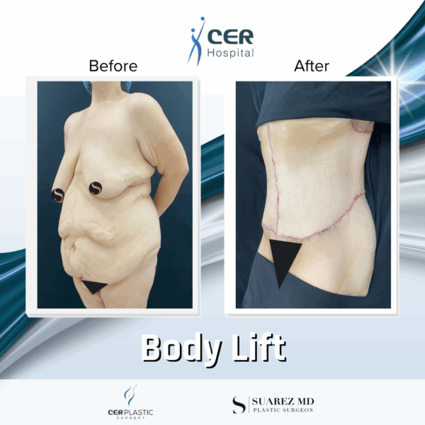 Body Lift - 7013 - Image 9