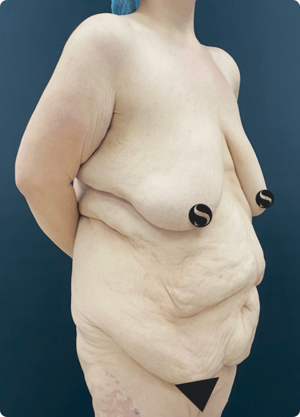 Body Lift - 7013 - Image 3