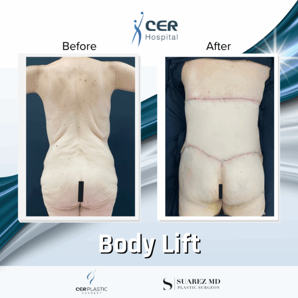Body Lift - 8013 - Image 9