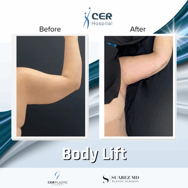 Body Lift - 11013 - Image 9