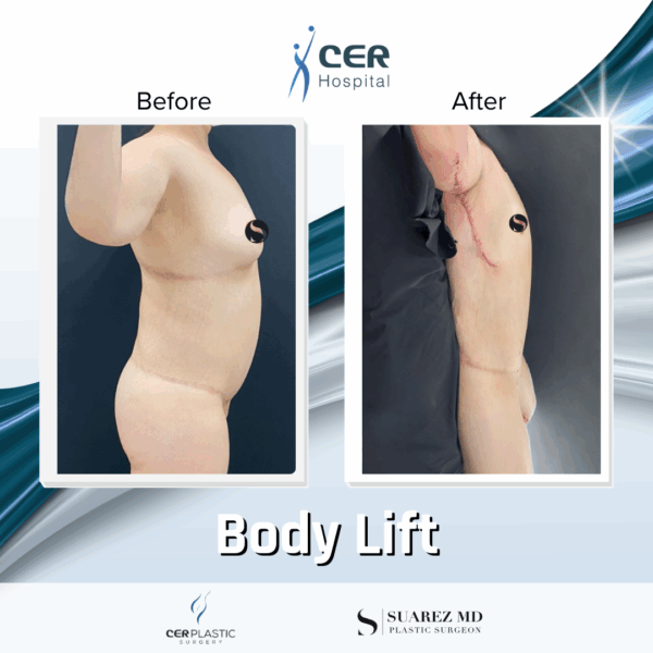 Body Lift - 20013 - Image 10