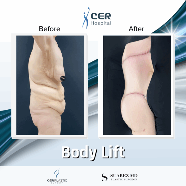 Body Lift - 20013 - Image 9