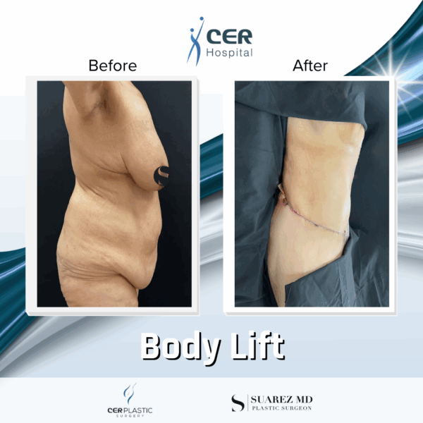 Body Lift - 23013 - Image 9