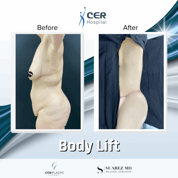 Body Lift - 13121 - Image 9