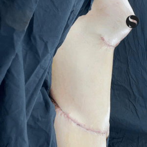 Body Lift – 13121