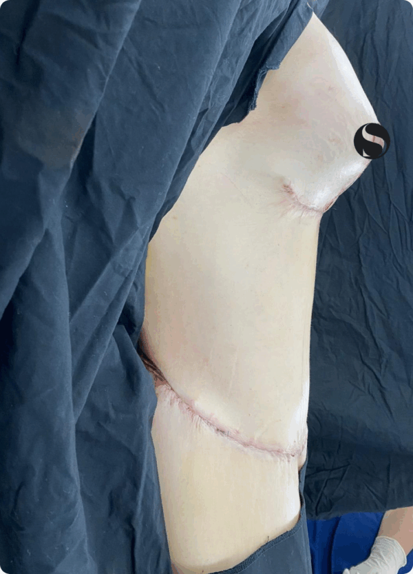 Body Lift - 13121 - Image 2