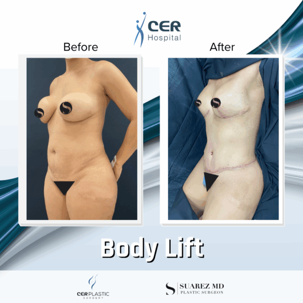 Body Lift - 26043 - Image 9