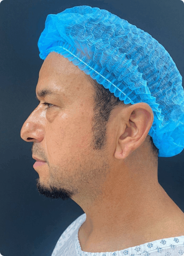 Lower Eyelid Surgery - 21043 - Image 3
