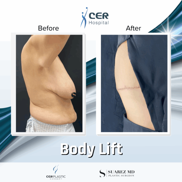 Body Lift - 10043 - Image 10