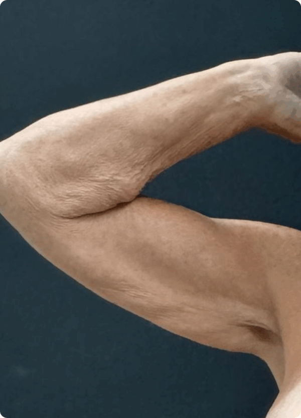 Body Lift - 18094 - Image 3