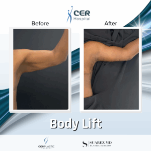 Body Lift – 19043