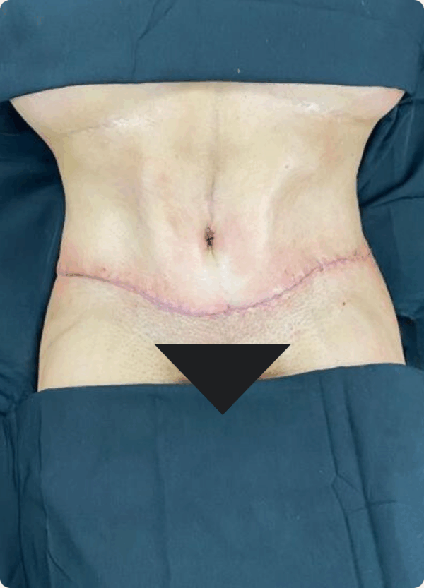 Body Lift - 2104 - Image 2