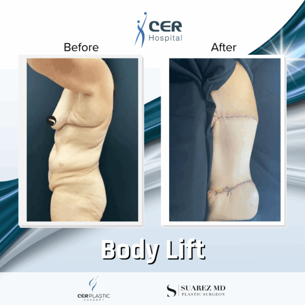Body Lift - 9104 - Image 6