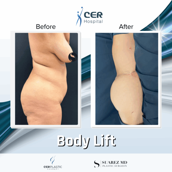 Body Lift - 20084 - Image 10
