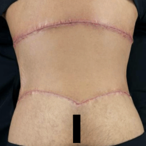 Body Lift – 3074