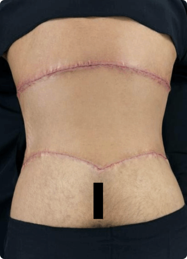 Body Lift - 3074 - Image 2