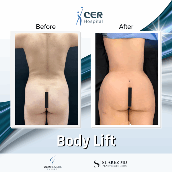 Body Lift - 22054 - Image 9