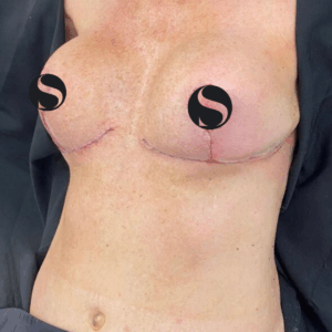 Breast Lift with Implant Exchange – 26084