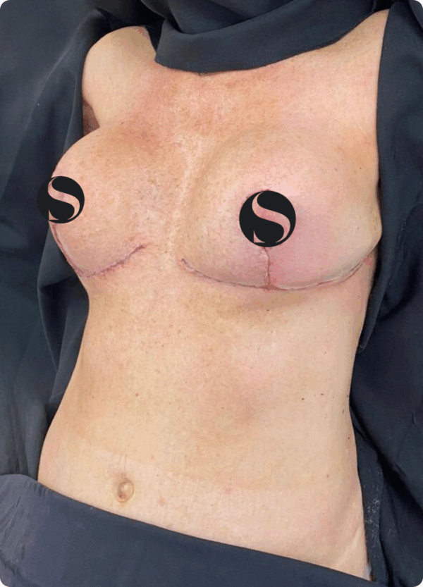 Breast Lift with Implant Exchange - 26084 - Image 2