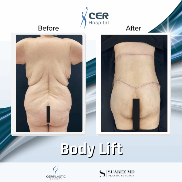 Body Lift - 7013 - Image 10