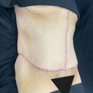 Body Lift – 7013