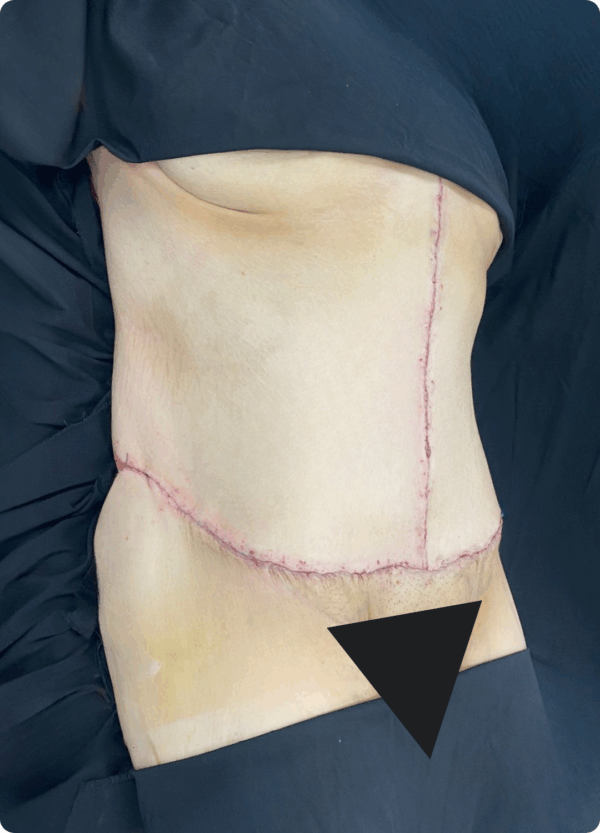 Body Lift - 7013 - Image 2