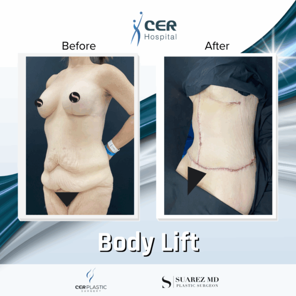 Body Lift - 8013 - Image 10