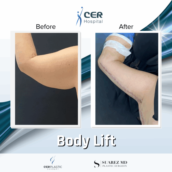 Body Lift - 11013 - Image 10